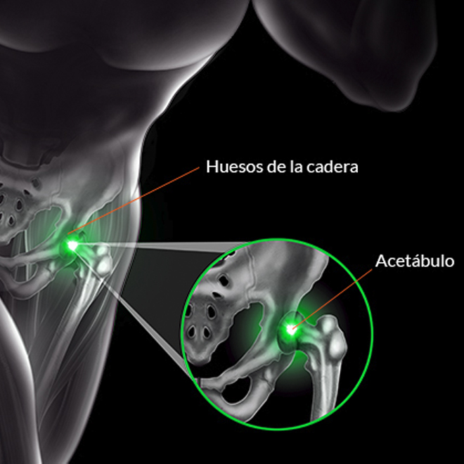 Prótesis de Rodilla